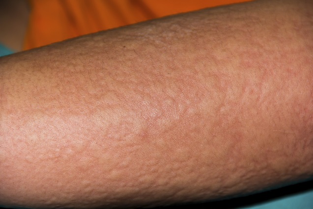 Urticaria