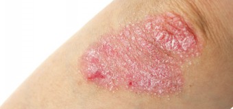 Schuppende Haut: Das löst Psoriasis aus